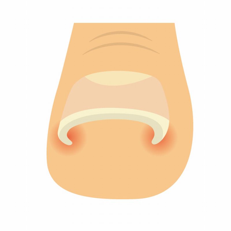 巻き爪